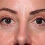 Blepharoplasty and Brow Lift Before & After Patient #34363